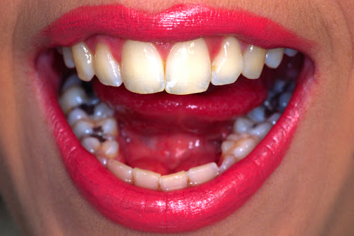 principales-enfermedades-dientes
