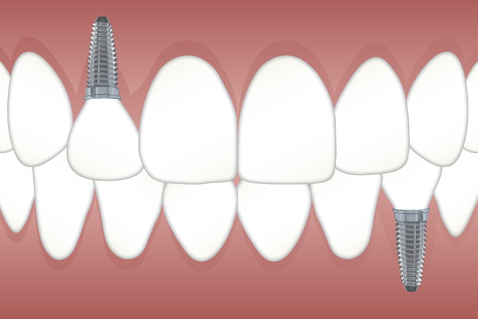teeth-3597679_960_720