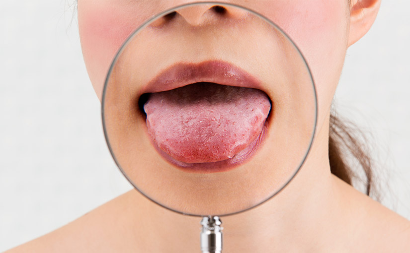 El síndrome de boca urente o ardiente se refiere a la sensación de dolor, escozor o ardor en la boca,